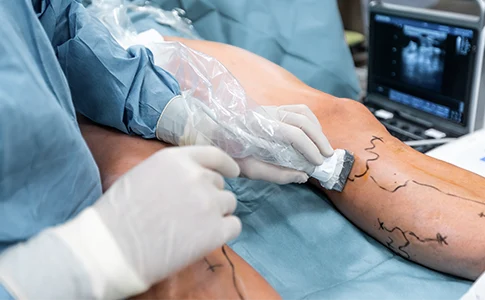 dr. felipe portela cirurgia de varizes