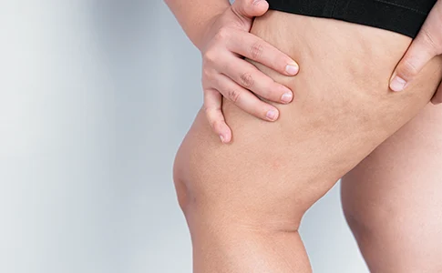 dr. felipe portela tratamento do lipedema